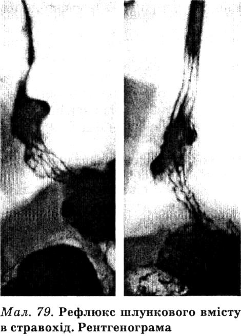 При рентгенографії стравоходу мож­на зафіксувати потрапляння контраст­ної речовини із шлунка в стравохід
