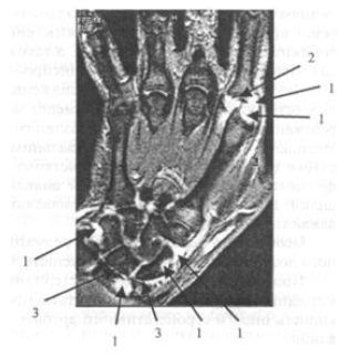 МРТ-дослідження кисті і променево-зап'ясткового суглоба у хворого на ревматоїдний артрит
