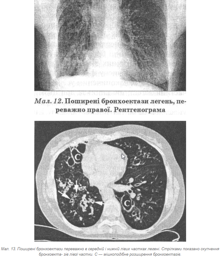 Поширені бронхоектази переважно в середній і нижній лівих частках легені