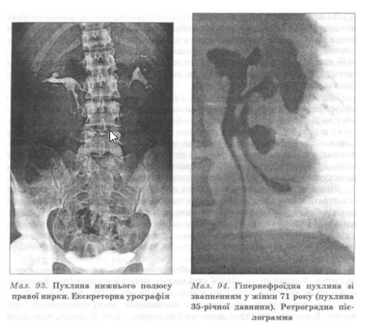 При оглядовій рентгенографії нирок можна виявити зміну контуру нирки за рахунок випинання пухлинного утворення