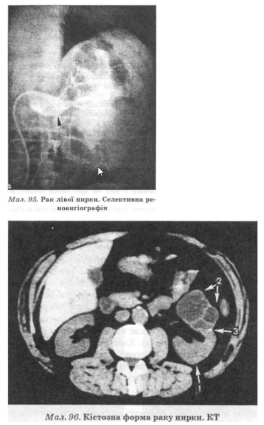 Комп'ютерна томографія є найінформативнішим і найважливішим методом діагностики пухлини нирки