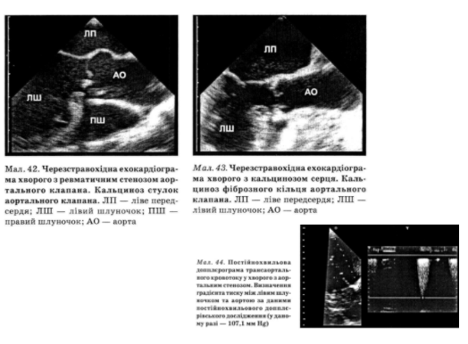Нині з урахуванням діагностичних можливостей ехокардіографії Допплєра катетеризацію серця у хворих із стенозом устя аорти виконують переважно для проведення корона­рографії 