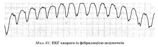 Підтвердити діагноз і встановити без­посередню причину раптової зупинки серця (фібриляція, асистолія шлуночків, електромеханічна дисоціація) дає змогу реєстрація ЕКГ.