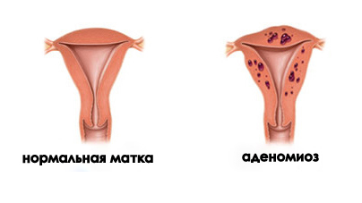 Порожнина матки покрита слизовою оболонкою, її ще називають ендометрій