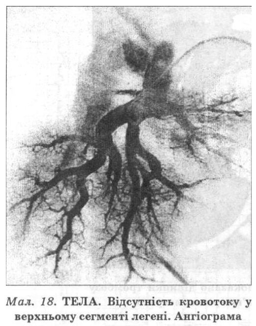 Косвенными ангиографическими симптомами ТЭЛА является расширение главных легочных артерий, уменьшение количества контрастованих периферийных ветвей (симптом мертвого дерева), деформация легочного рисунка.