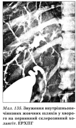 При проведении эндоскопической ретроградной холангиопанкреатографии определяют внутрипеченочные желчные протоки