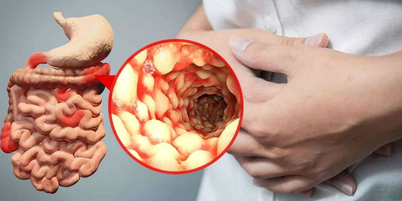 Болезнь Крона - гранулематозные воспалительное заболевание с сегментарным трансмуральным поражением любого отдела пищеварительного тракта