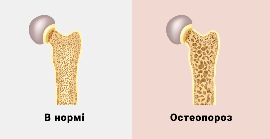 Остеопороз — системне захворювання скелета, яке характеризується прогресивним зниженням кісткової маси, порушенням мікроархітектоніки кісткової тканини з подальшим підвищенням крихкості кісток і збільшенням ризику їх переломів.